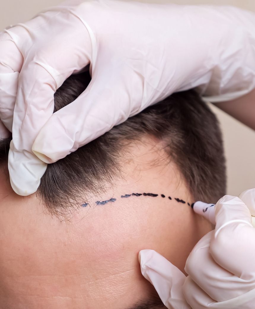 Other Transplant Correction Other Transplant Correction